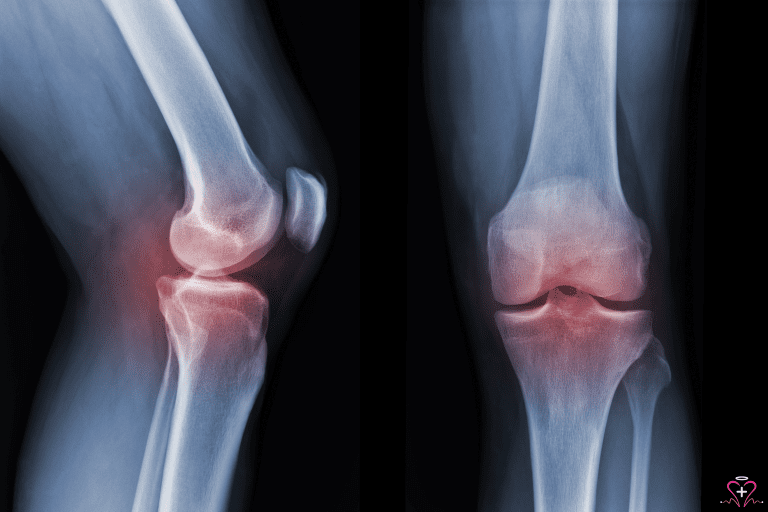 Rheumatology: Diagnosing and Treating Joint Inflammation