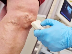 Gloved medical professional performing vascular ultrasound on senior patient’s leg to assess varicose veins and swelling.