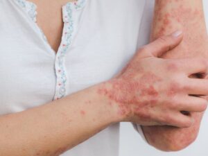 Lyme disease rash on an older adult’s arm – early symptoms, prevention, and treatment for seniors.
