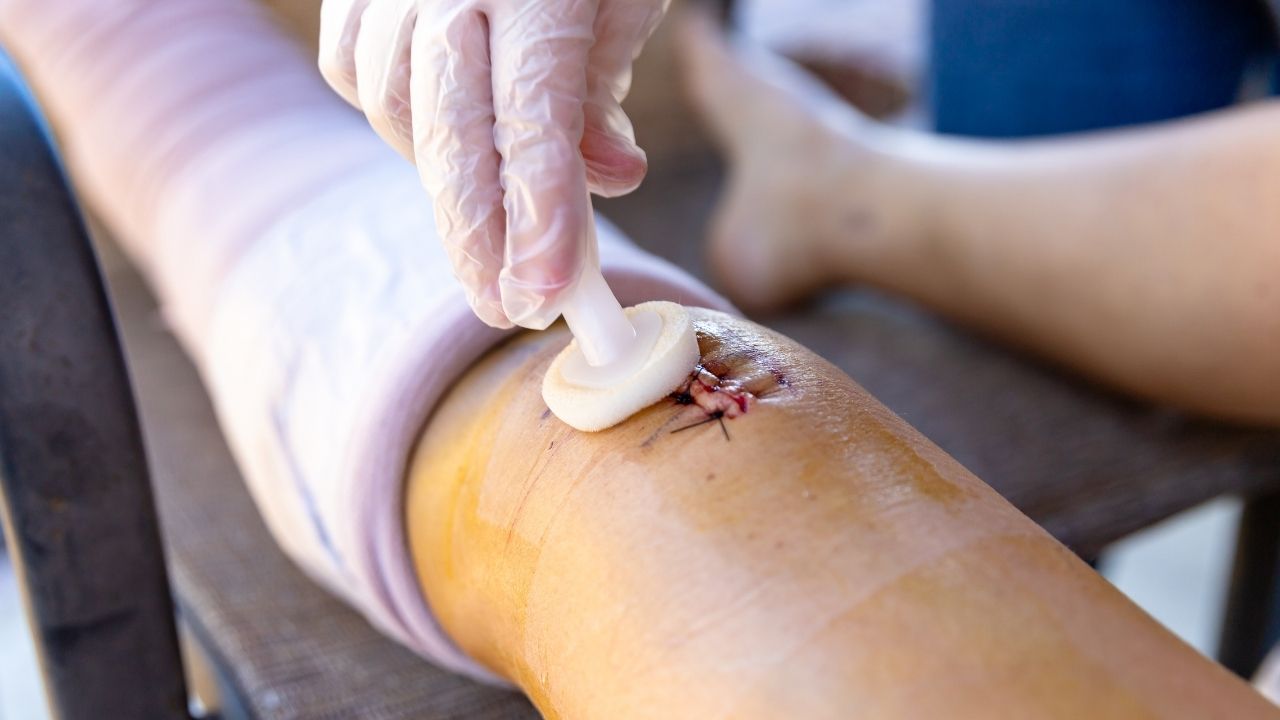 Sårbehandling etter operasjon: Komplett guide til helbredelse, image size:1280x720