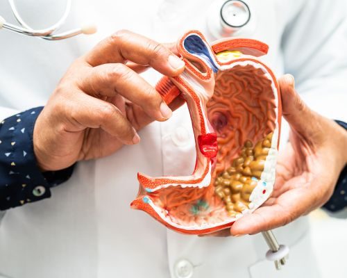 Colorectal Cancer